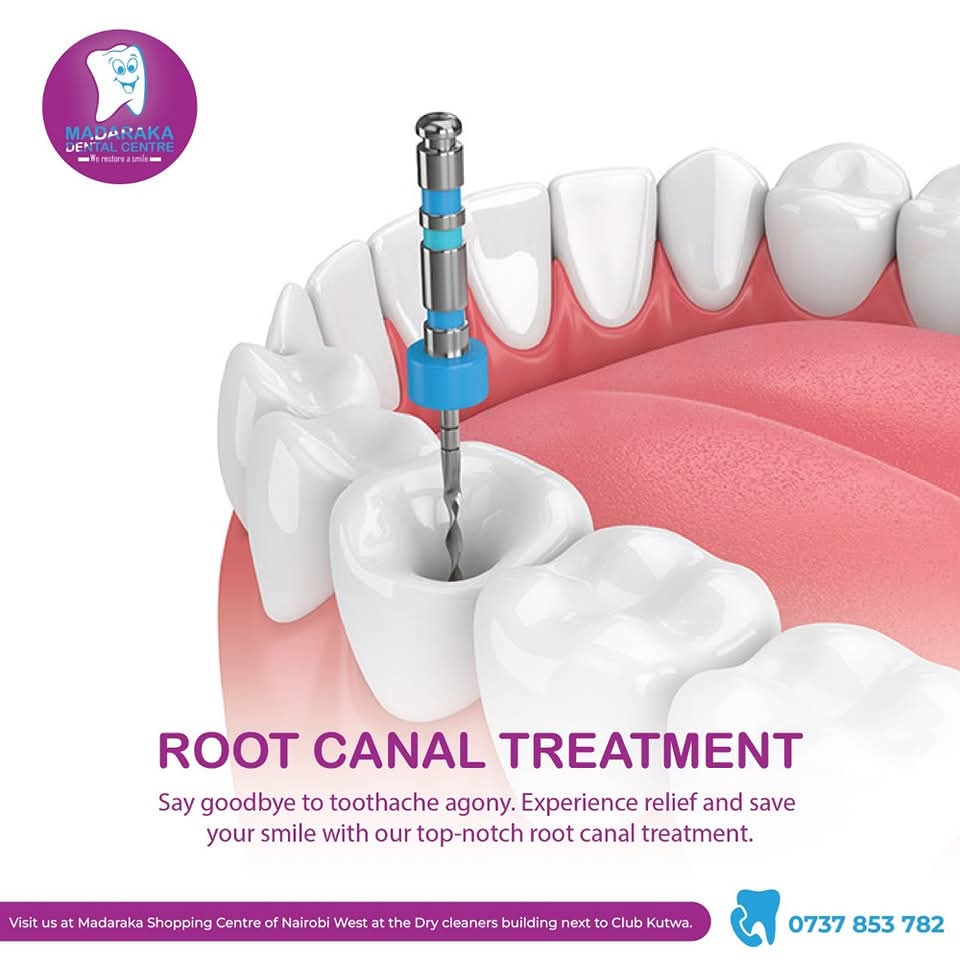 Endodontic Treatments